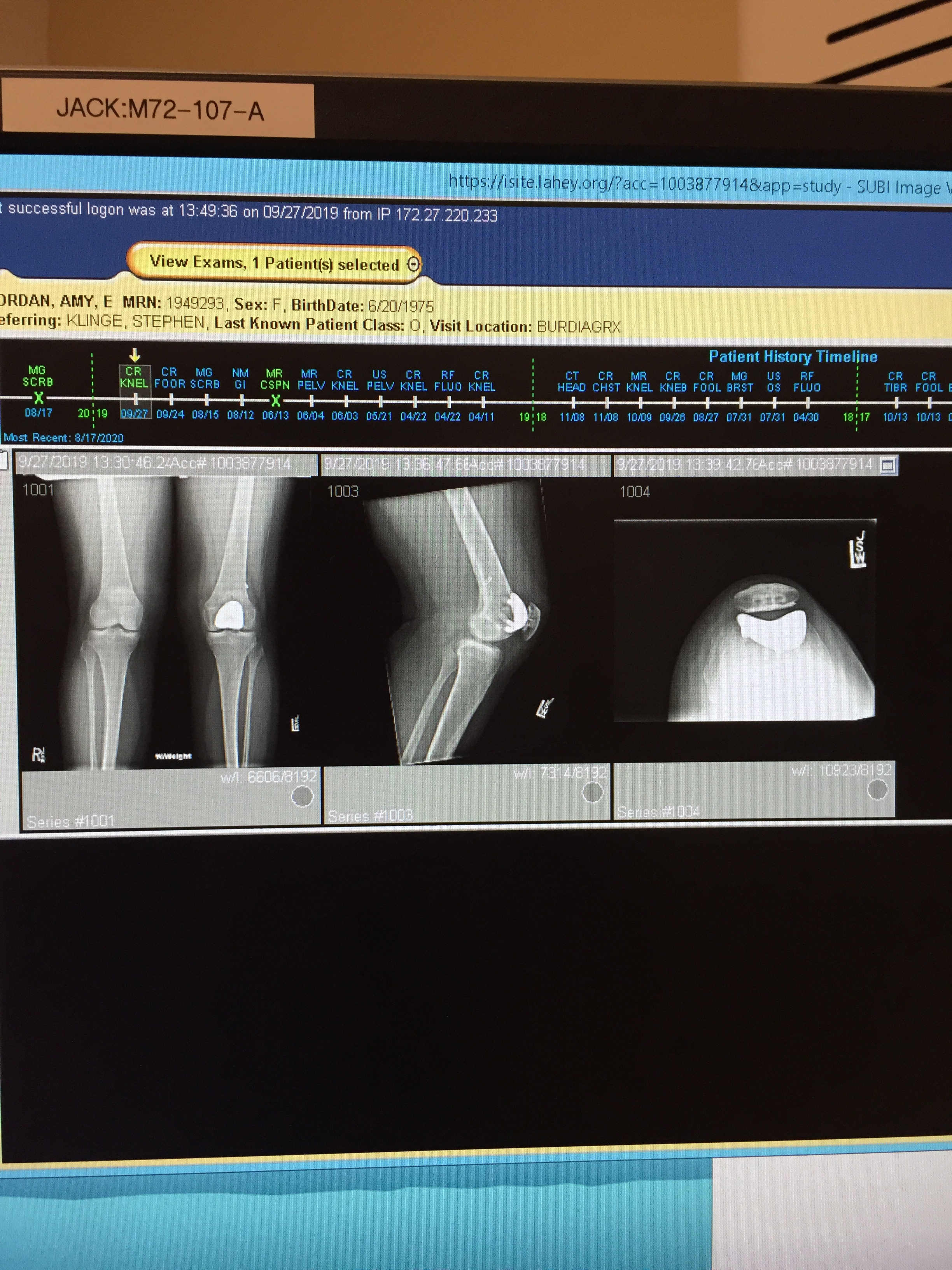 Knee Surgery Recovery