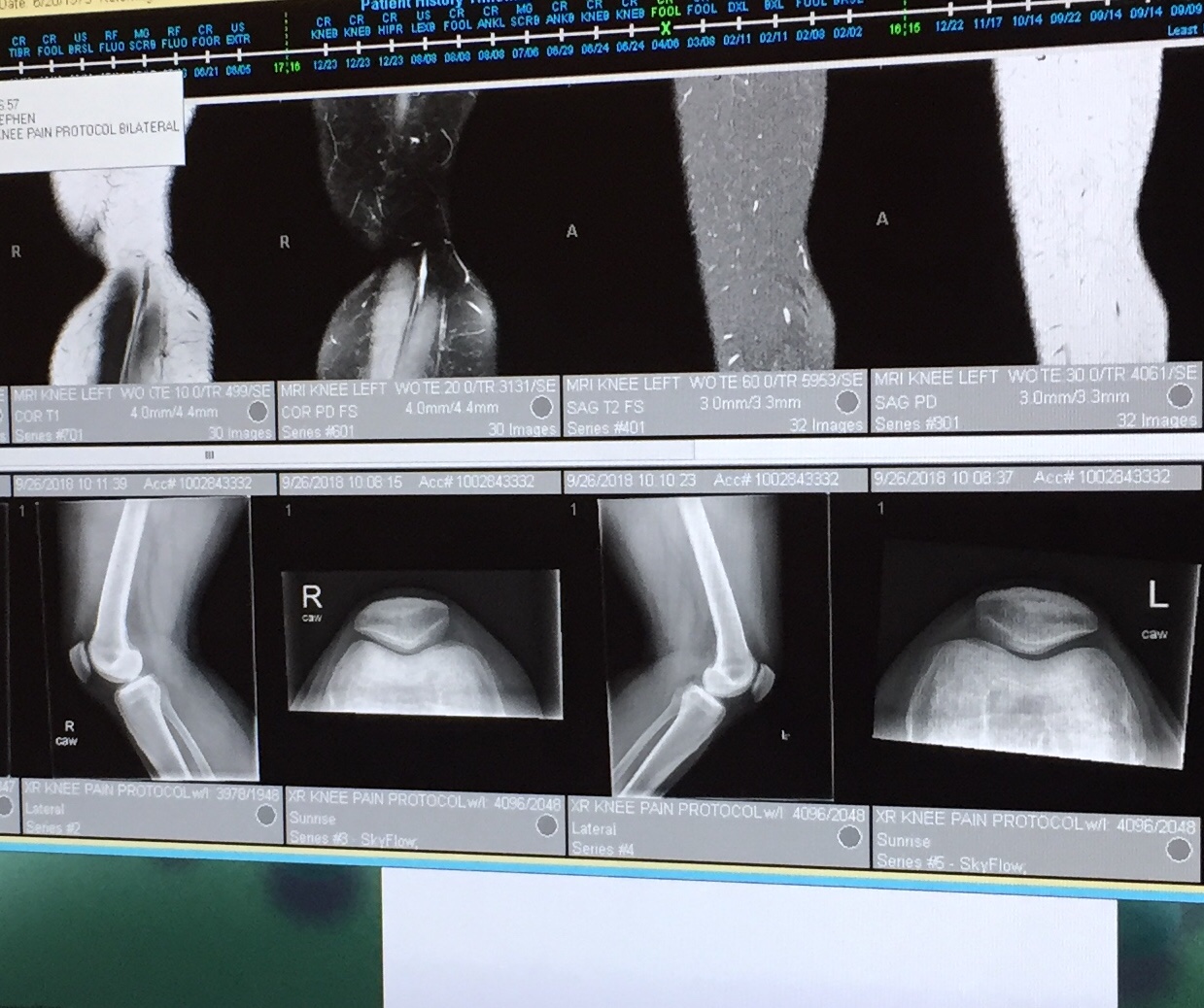 Patellofemoral Arthroplasty